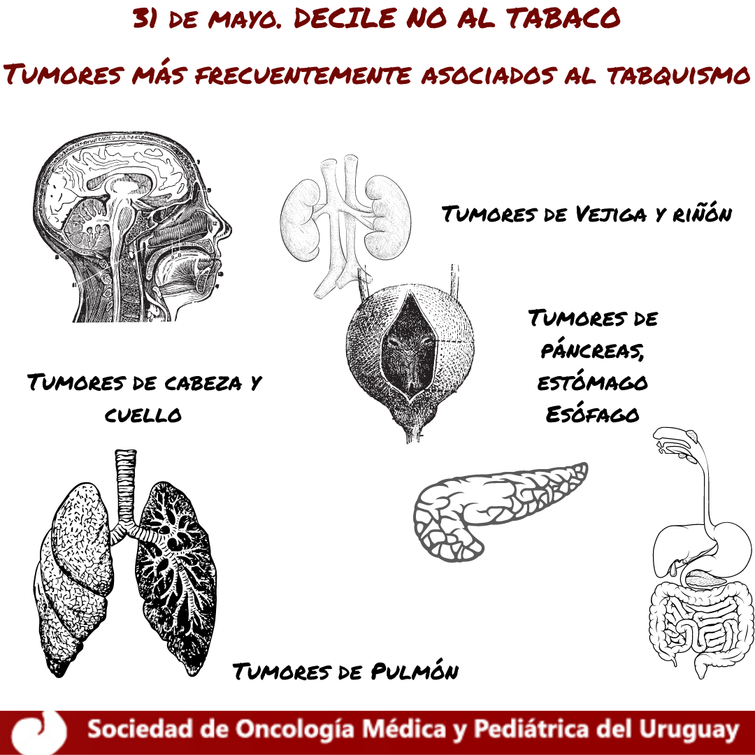 Infografía con los cánceres más frecuentes causados por el consumo de tabaco.